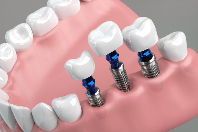 歯がボロボロでもインプラントで治せる？美しい歯並びを実現する方法
